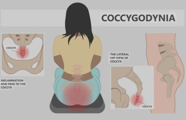 How Can GS Physiotherapy Provide the Best Coccydynia Treatment in Sector 51, Gurgaon?