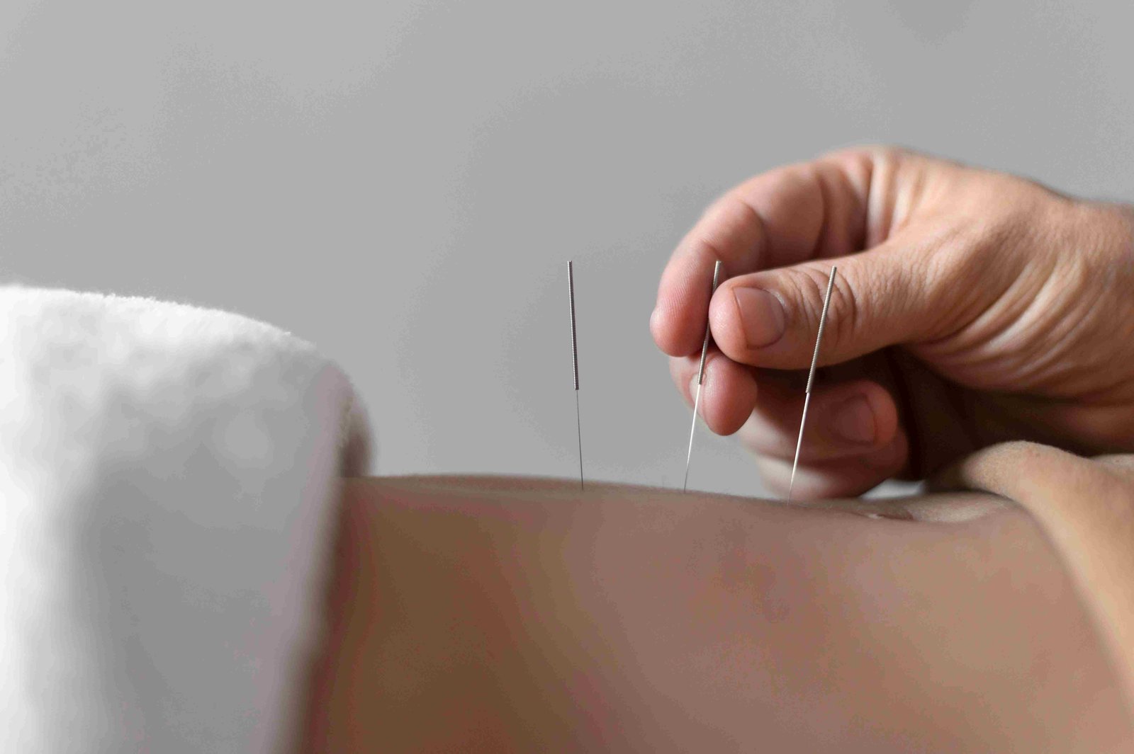 Dry Needling